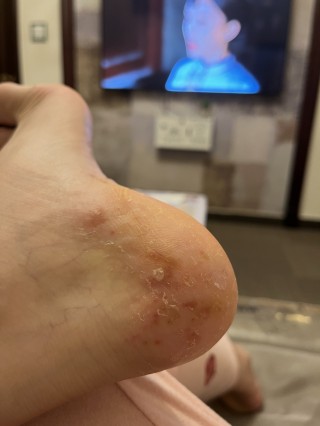 脚上起小水泡还很痒是怎么回事(脚上起小水泡很痒是怎么回事照片)